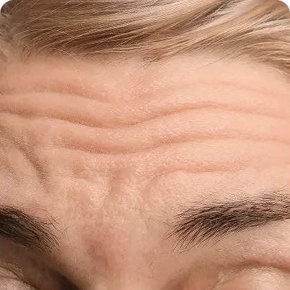 Botox